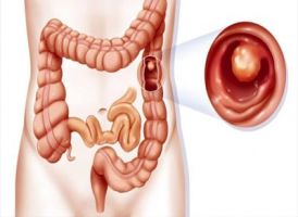 Trị bệnh đại tràng