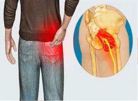 Trị đau thần kinh tọa