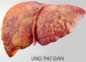 Trị ung thư gan