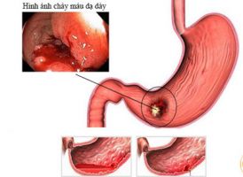Trị viêm xung huyết dạ dày