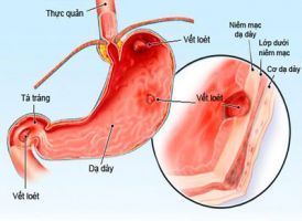 Trị bệnh viêm loét dạ dày